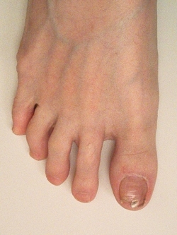 Healthy toenail growth appears
                    after three weeks of treatment