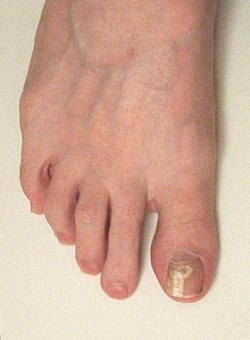 Healthy toenail growth appears after three 
                    weeks of treatment